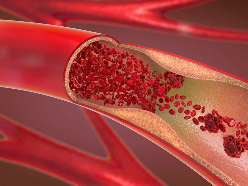 10-dau-hieu-canh-bao-cua-mot-cuc-mau-dong-khong-the-bo-qua