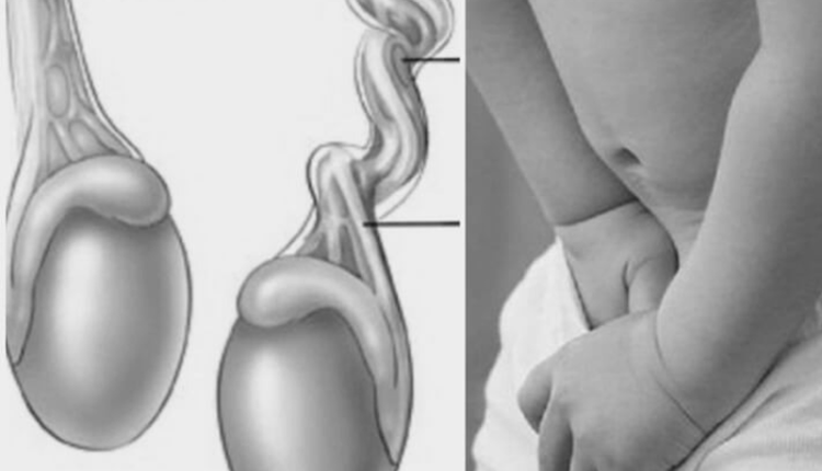 tinh-hoan-lac-vao-o-bung-suot-50-nam-to-nhu-trung-da-dieu