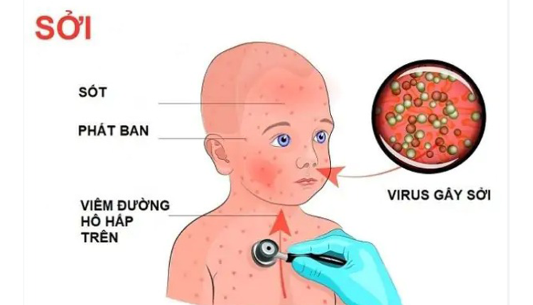 benh-soi-nhung-dieu-ai-cung-can-biet-de-bao-ve-suc-khoe