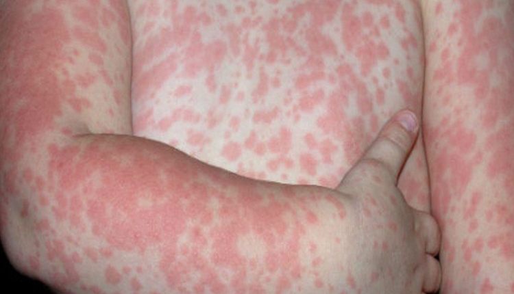 bệnh sởi ở trẻ em