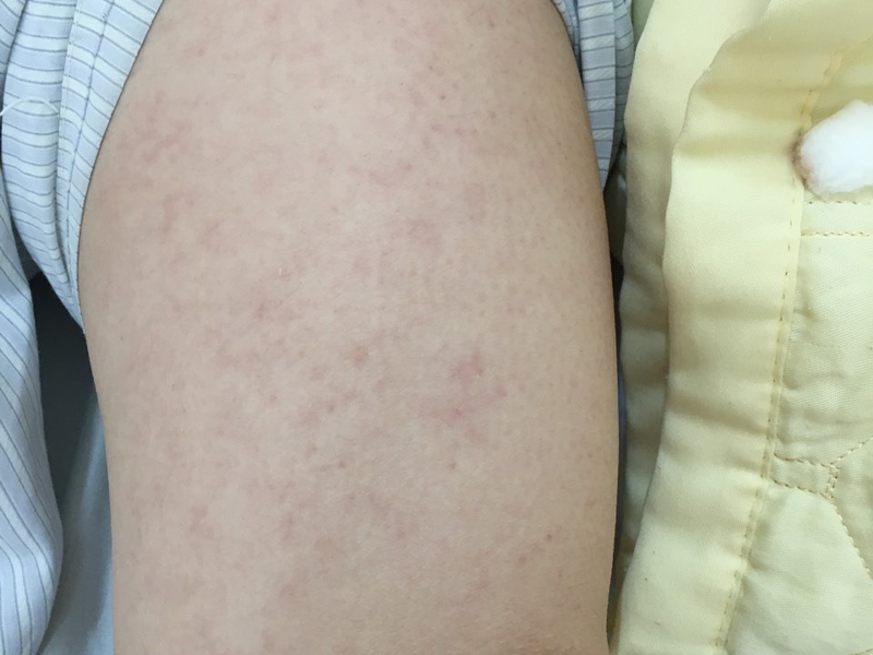 bệnh sởi ở trẻ em