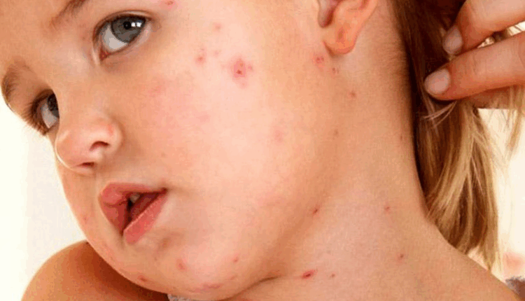 phan-biet-ban-soi-va-sot-phat-ban-cach-nhan-biet-dung-de-cham-soc-va-phong-ngua-hieu-qua